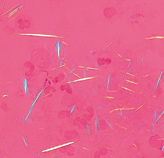 尿酸结晶，偏光